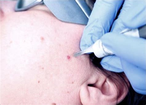 electrocautery milia mole skin tags and warts removal