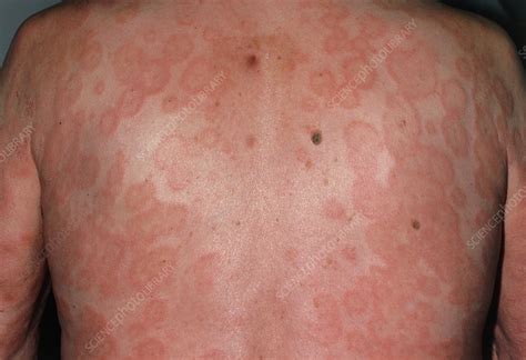 erythema multiforme skin rash on back of male stock