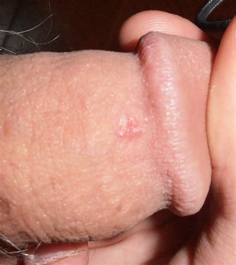 blister on penis web sex gallery