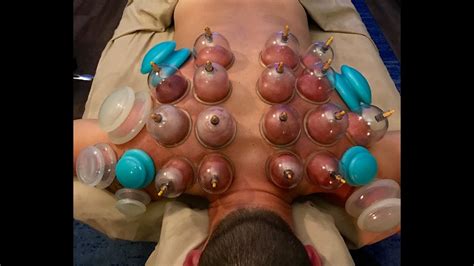 cupping therapy youtube