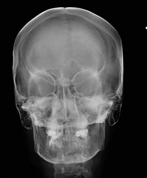 skull x ray pa view buyxraysonline