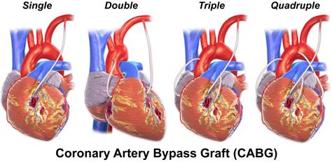 heart bypass surgery coronary artery bypass surgery risks recovery time