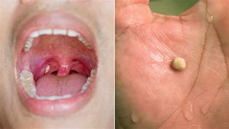 Tonsil Stones How To Treat Them Ent Specialist Singapore