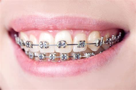 mastering the art of invisalign surviving the first week with a smile