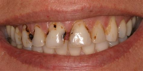 Tooth Decay Pictures Cosmetic Dentistry