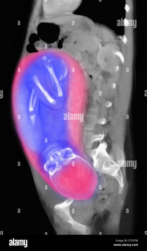 ct scan of abdomen of 25 year old pregnant woman with full term stock
