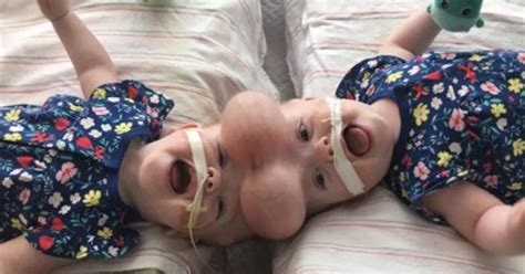 Formerly Conjoined Twins Go Home For The First Time