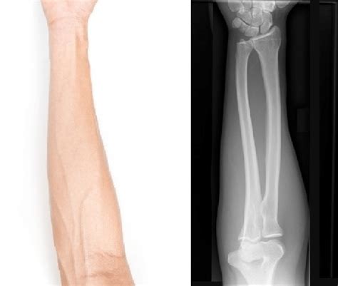 ray picture  natural picture  human forearm   scientific diagram