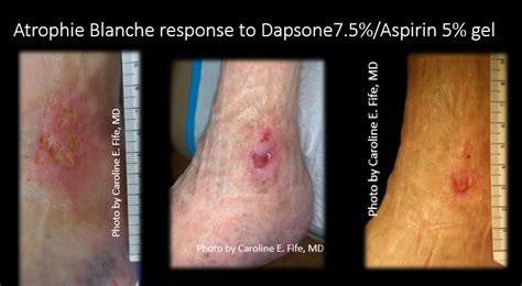 hope  atrophie blanche  compounded topical dapsone  aspirin