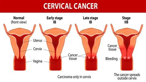 cervical cancer 5 signs never to ignore womenworking