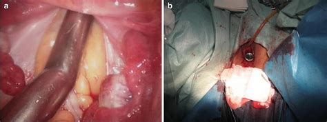 Retracted Article Peritoneal Vaginoplasty By Luohu I And