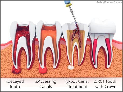 root canal treatment root canal therapy endodontics zanesville