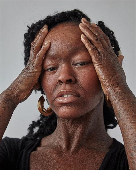 Woman Who Sheds Skin Every Two Weeks Becomes Probably The First Model