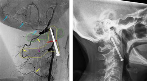 Odontoid Fracture Spine Orthobullets