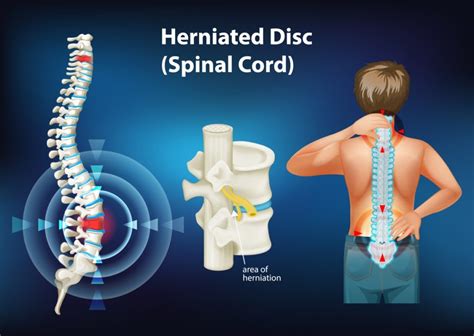 slipped disc treatment disc replacement surgery singapore