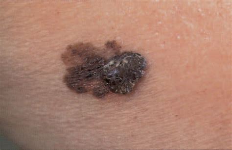 You Dont Need A Mole To Get Deadly Melanoma Live Science