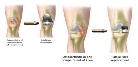 Partial Knee Replacement In Hyderabad Udai Omni Hospital