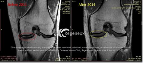 stem cells  knee arthritis regenexx
