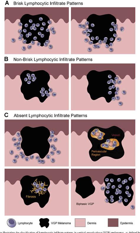 Figure 1 From Tumour Infiltrating Lymphocytes In Melanoma Prognosis And