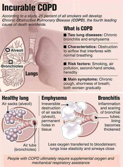 Hemothorax Chronic Obstructive Pulmonary Disease Dysphagia Lung Hot