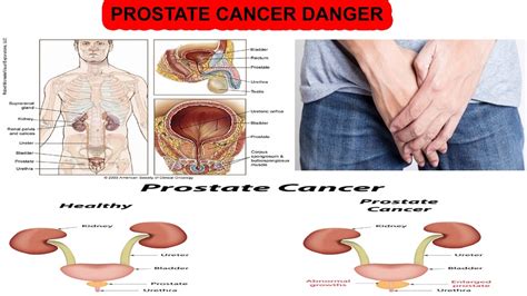 prostate cancer symptoms what is prostate cancer what is prostate