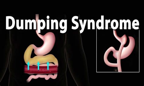 dumping syndrome international consensus  management released