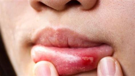 What Causes A Canker Sore And 13 Natural Ways To Heal It