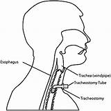 Tracheostomy Tracheal Stenosis Bmj Casereports sketch template