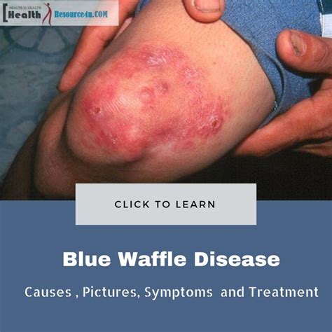 Pin On Blue Waffle Disease
