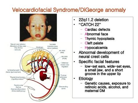 pin  nonas arc  digeorge syndrome digeorge syndrome pediatrics
