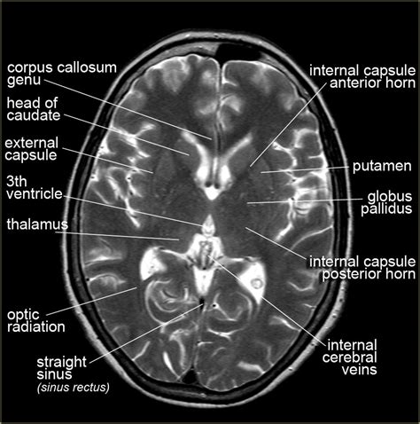 brain anatomy on mri