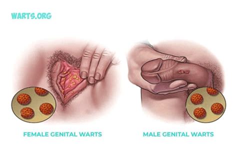 pictures of genital warts on the penis hot nude