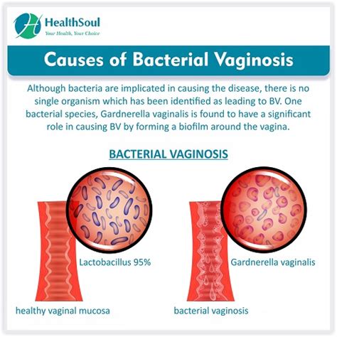 Bacterial Vaginosis Causes Symptoms And Treatment Healthsoul