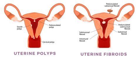 What Is The Difference Between Uterine Polyps Vs Fibroids