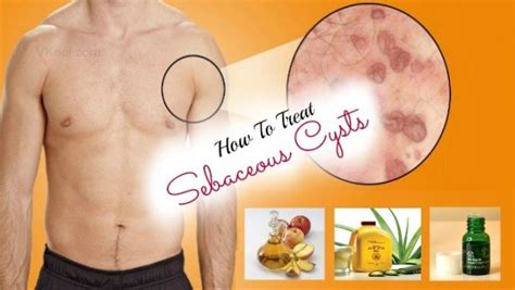 12 ways on how to treat sebaceous cysts naturally at home