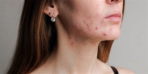 science  turmeric acne turmeric benefits