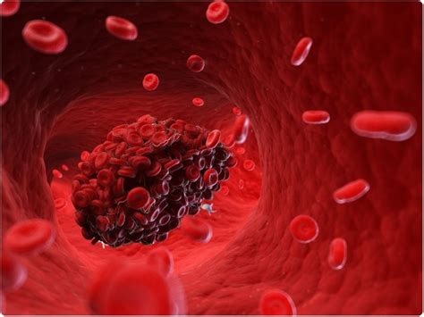 tool distinguishes     types  blood clots