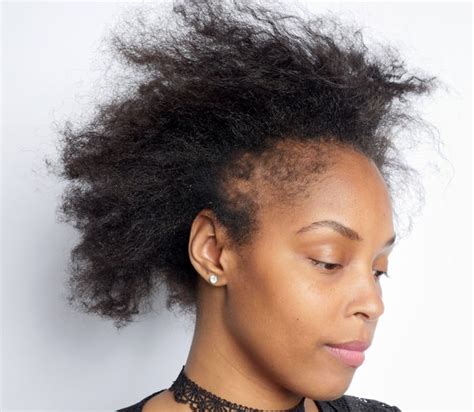 What Black Women Need To Know About Hair Loss The New York Times