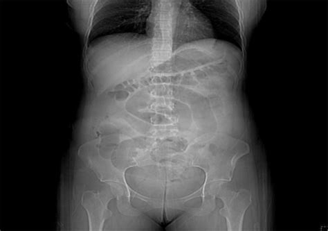 Abdominal X Ray Consistent With A Partial Small Bowel O