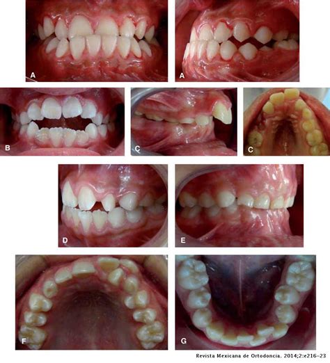 prevalence of malocclusions associated with pernicious oral habits in a