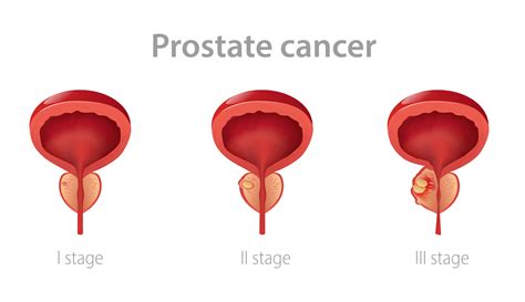 Understanding Prostate Cancer Treatment For Gay And Bisexual Men – GarÇon