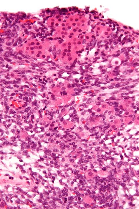 leydig cells and sertoli cells — sex cord stromal tumor of the testis
