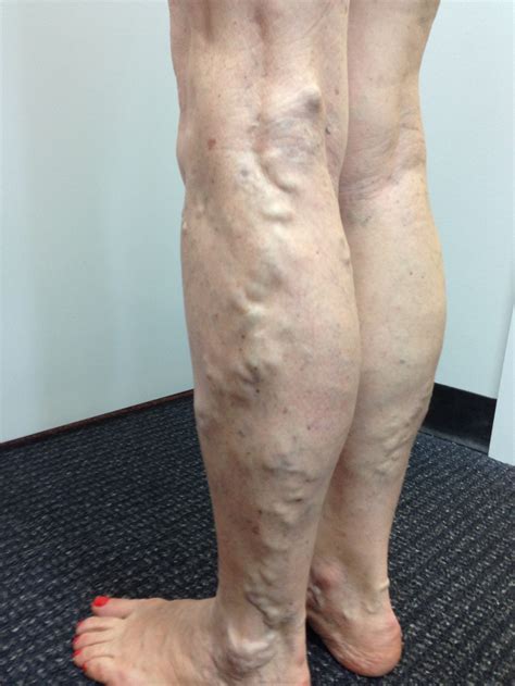 varicose vein results  post treatment   leg vein doctor