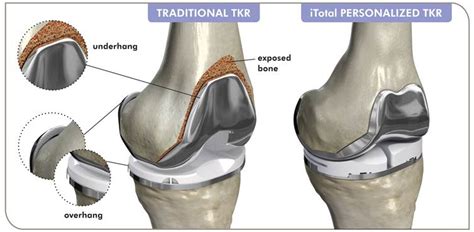 The Conformis Advantage Connecticut Knee Surgery