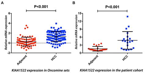 High Kiaa1522 Expression Predicts A Poor Prognosis In Patients With