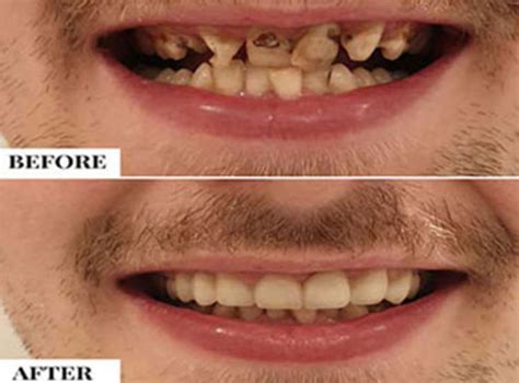 fix crooked teeth stunning dentistry blog