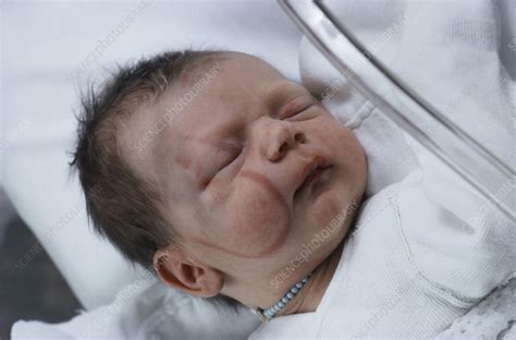 forceps mark  face newborn baby stock image  science