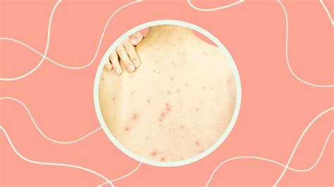 How To Treat Adult Body Acne — Breast Back And Butt Sheknows