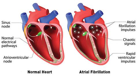 Atrial Fibrillation Afib Treatment Froedtert And Mcw