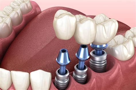 dental implants northwoods dental spa